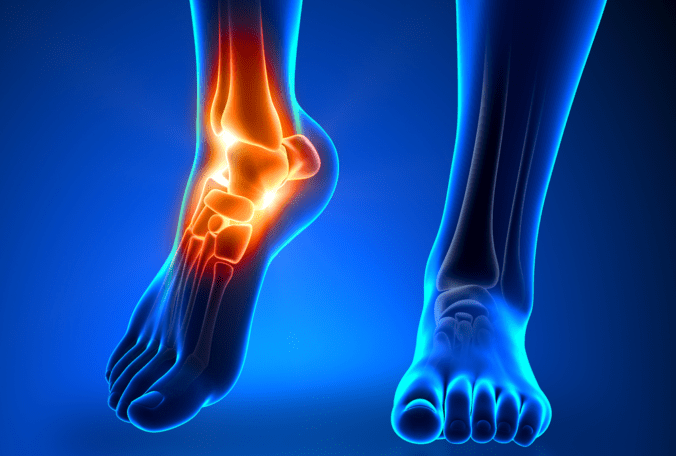 A visual representation of two feet and lower legs, with the right ankle highlighted in a warm orange tone to represent an injury.
